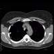 Silicosis, pulmonary silicosis: CT - Computed tomography